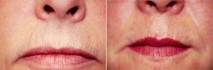 Microdermabrasion Patient, Before and After Photo
