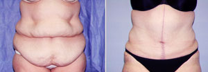 Abdominoplasty Patient, Before and After Photo