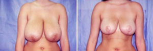 Breast Reduction Patient, Before and After Photo