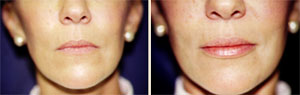 Lip Augmentation Patient, Before and After Photo