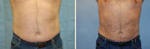 Male Liposuction Patient, Before and After Photo