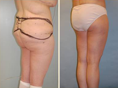 Lower Body Lift Patient, Before and After Photo