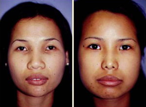 Rhinoplasty Patient, Before and After Photo