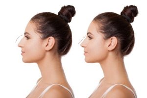 Rhinoplasty nose surgery in Seattle