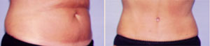 Bikini Belly Button Tummy Tuck Patient, Before and After Photo