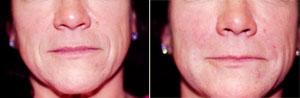 Restylane Patient, Before and After Photo