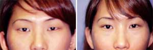 Asian Eyelid Surgery Patient, Before and After Photo