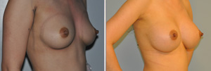 Breast implant patient, before and After photo