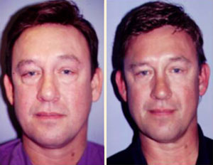 Eyelid Surgery Patient, Before and After Photo