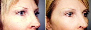 Brow lift Patient, Before and After Photo