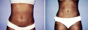 Patient of Color, Liposuction before and after photo