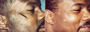 Scar Reduction Patient, Before and After Photo